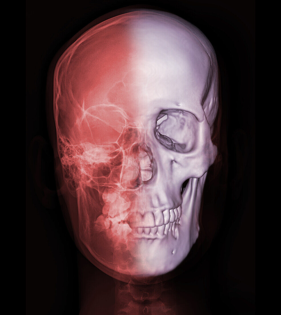 Human skull, X-ray