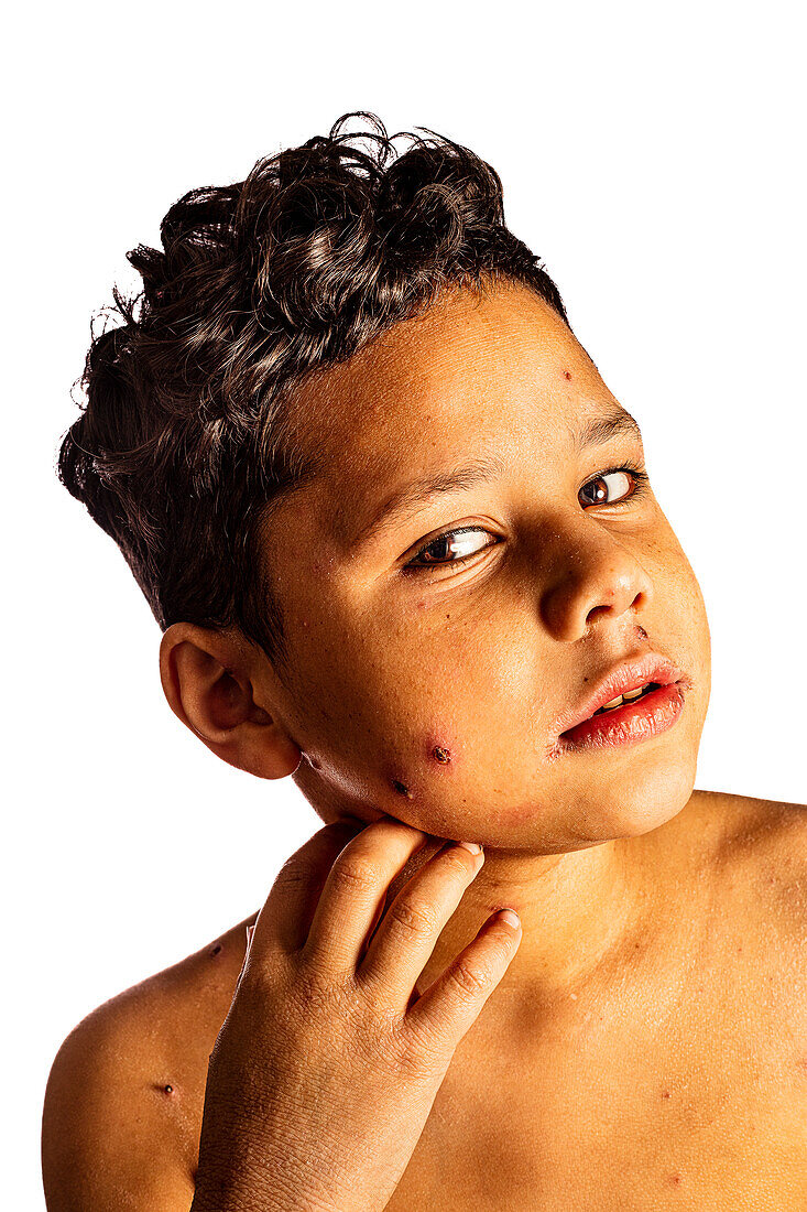 Boy with chickenpox