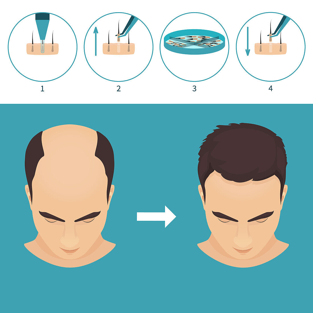 FUE hair transplantation, illustration