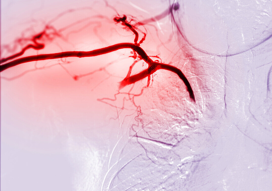Treatment for blocked arteries, angiogram