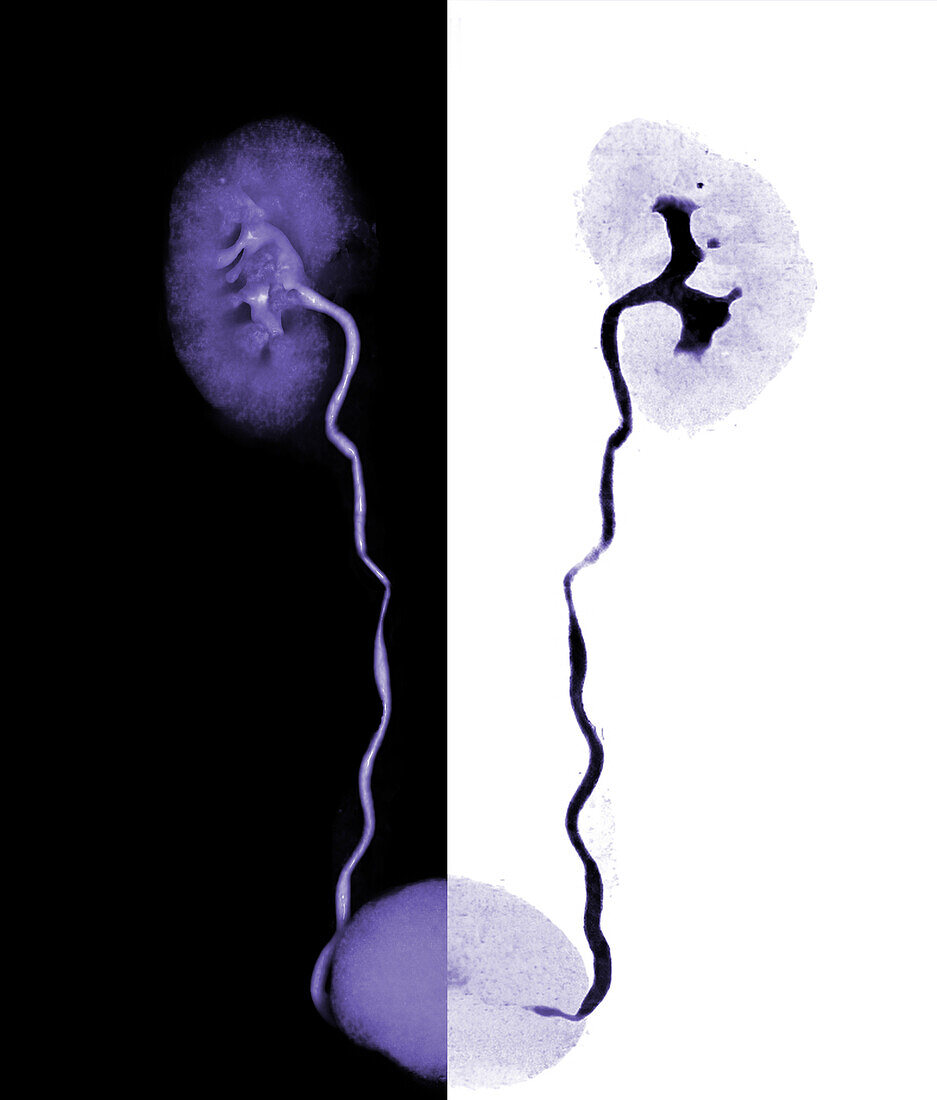 Urinary system, CT scan