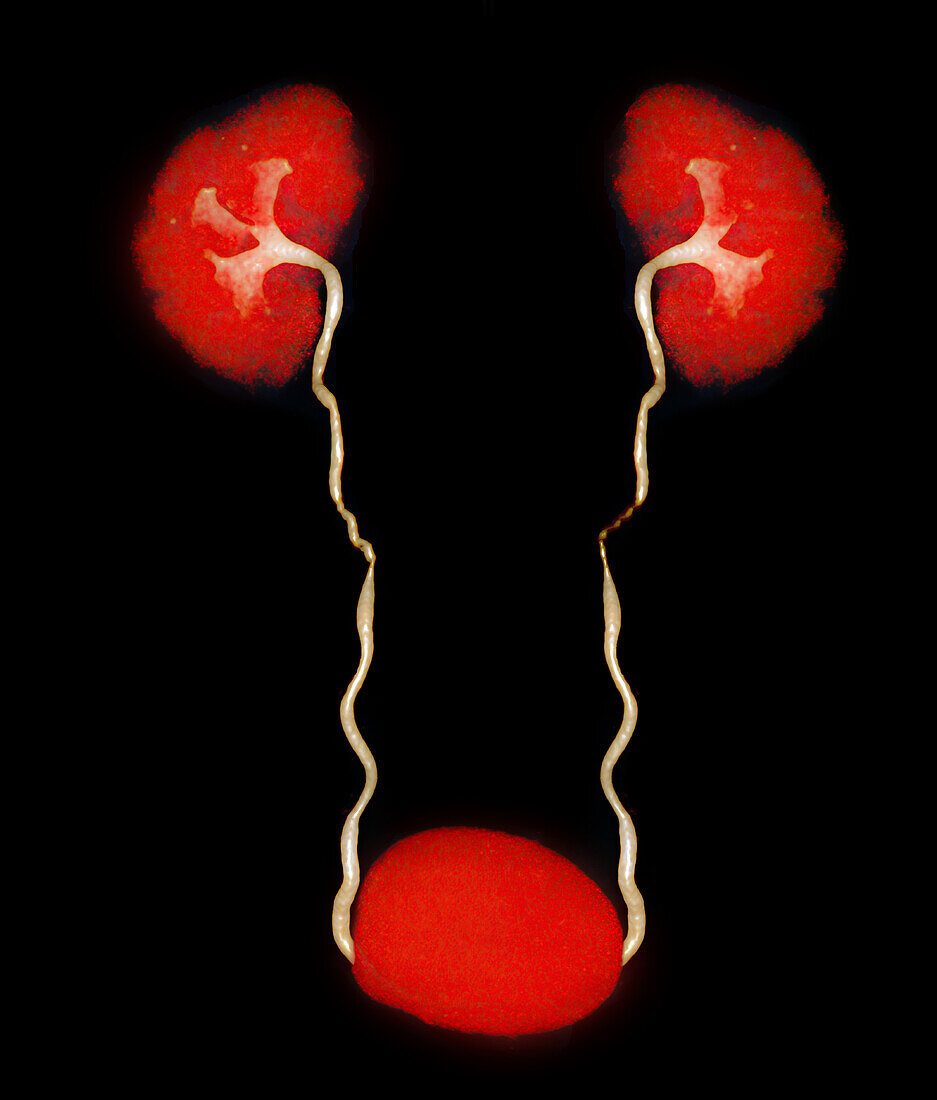 Urinary system, CT scan