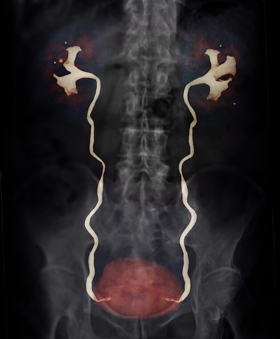 Urinary system, CT scan and X-ray