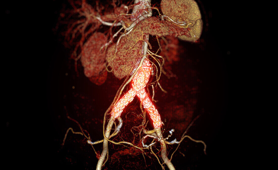 Stent in aortic aneurysm, CT scan