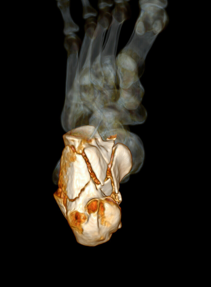 Fractured heel, CT scan