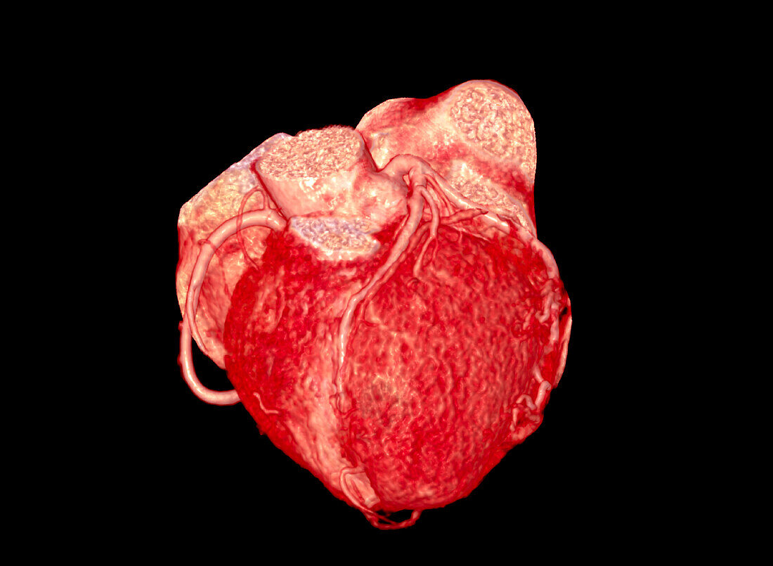 Healthy coronary arteries, CT scan