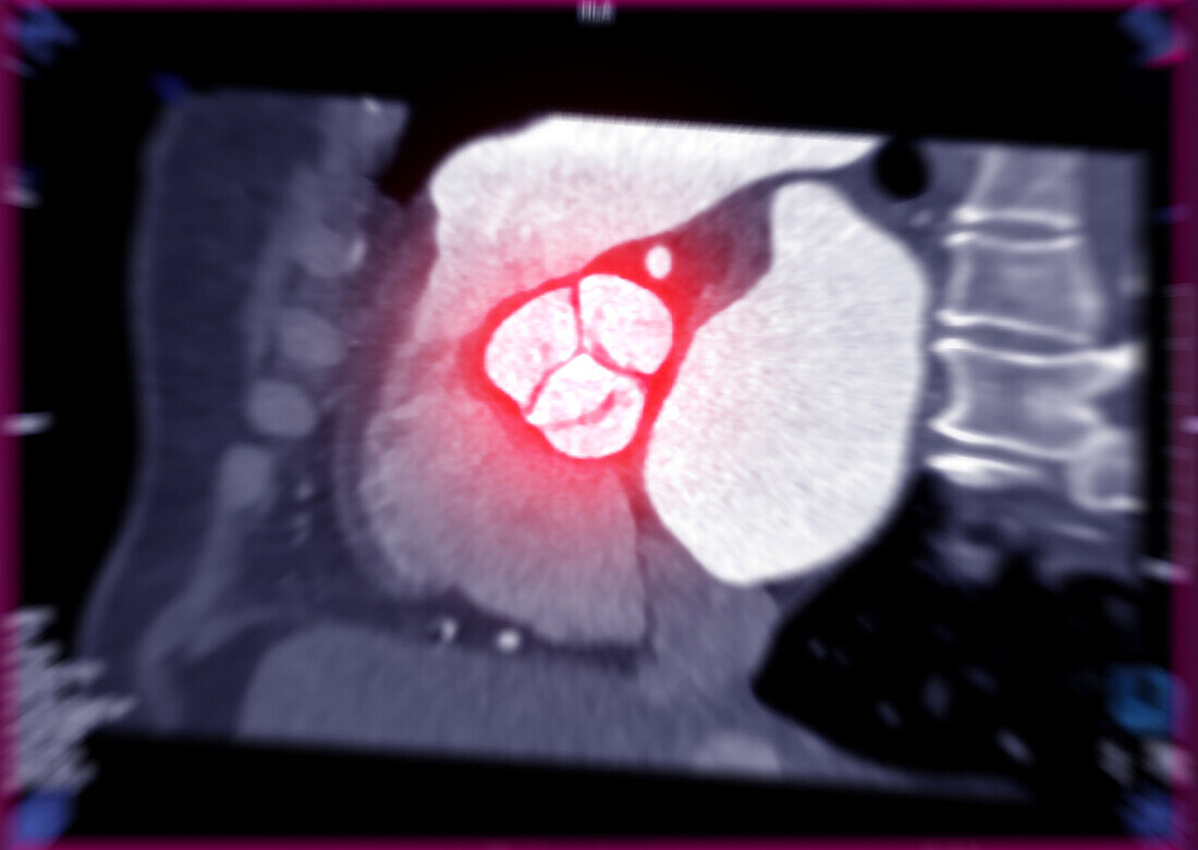 Healthy aortic valve, CT scan