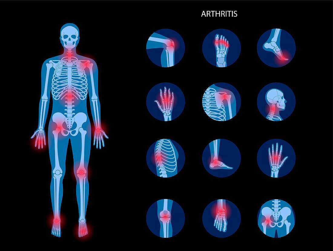 Arthritis, conceptual illustration