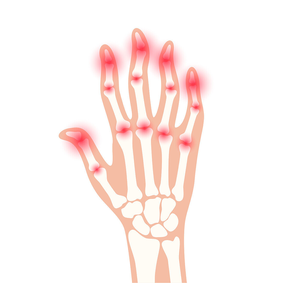 Arthritic hand, conceptual illustration