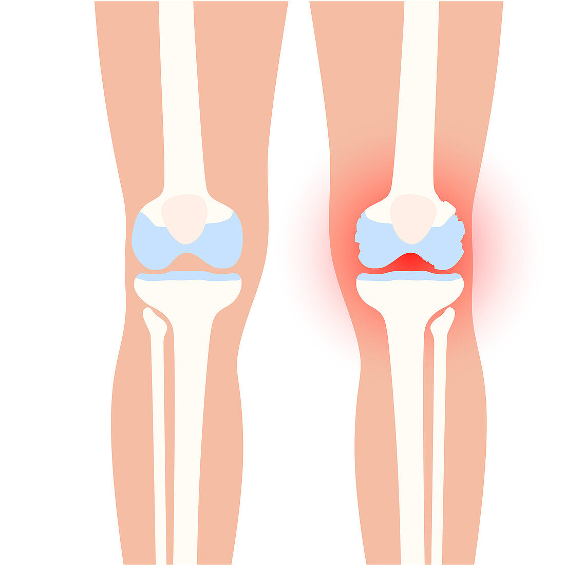 Arthritis of the knee, conceptual illustration