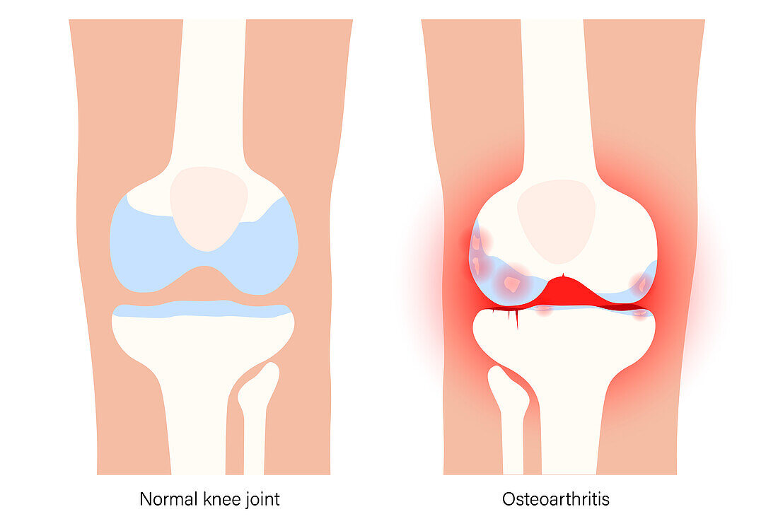 Arthritis of the knee, conceptual illustration