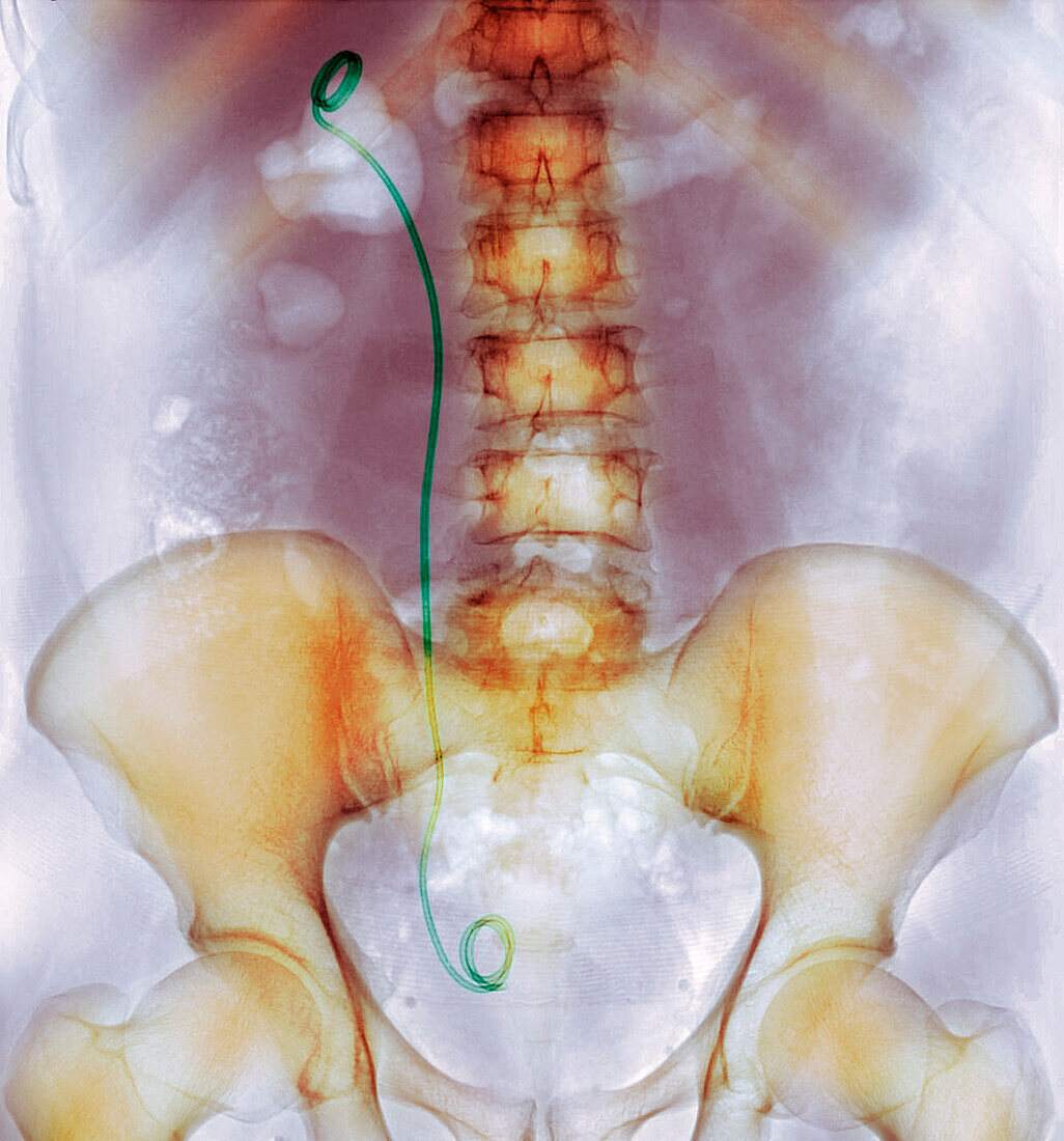 Urinary system stent, X-ray