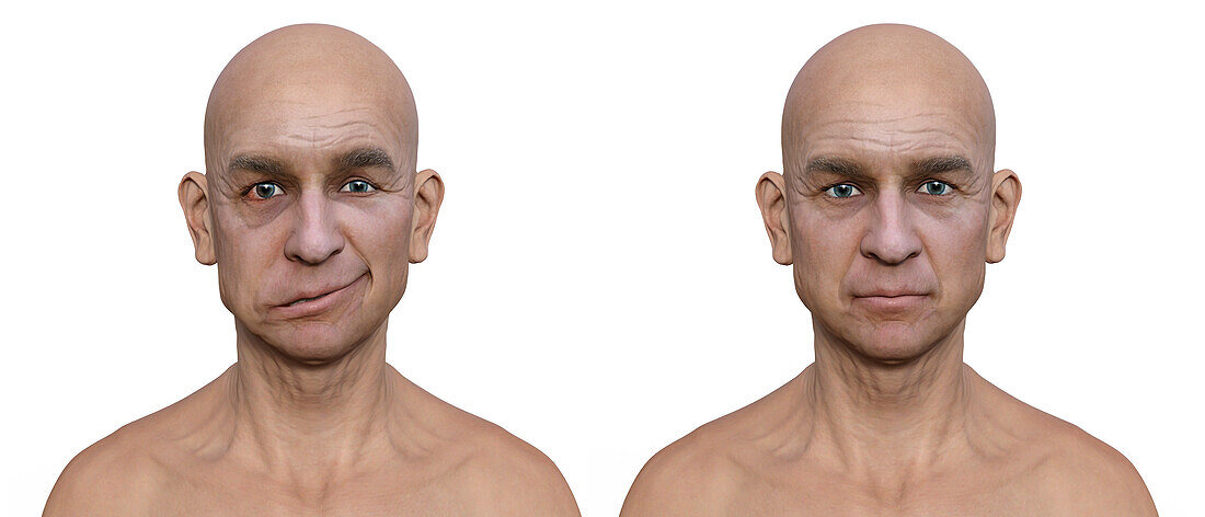 Healthy man and man with facial palsy, illustration