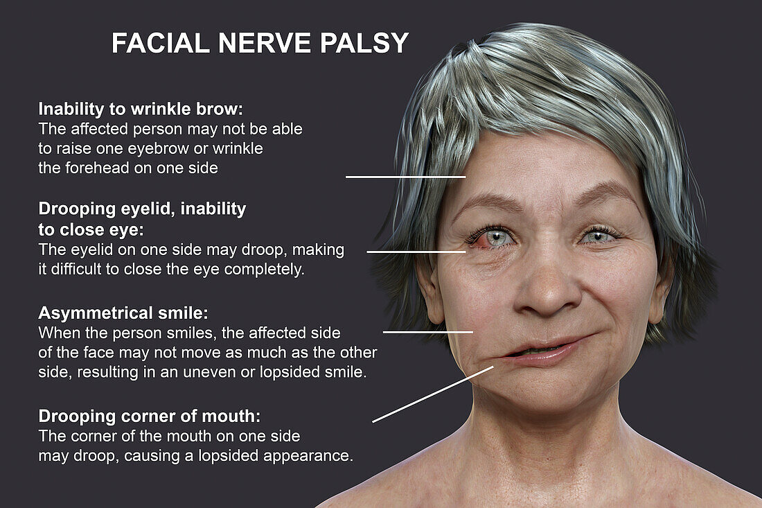 Facial palsy, illustration