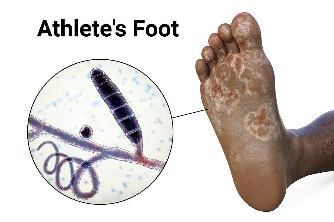 Athlete's foot, illustration