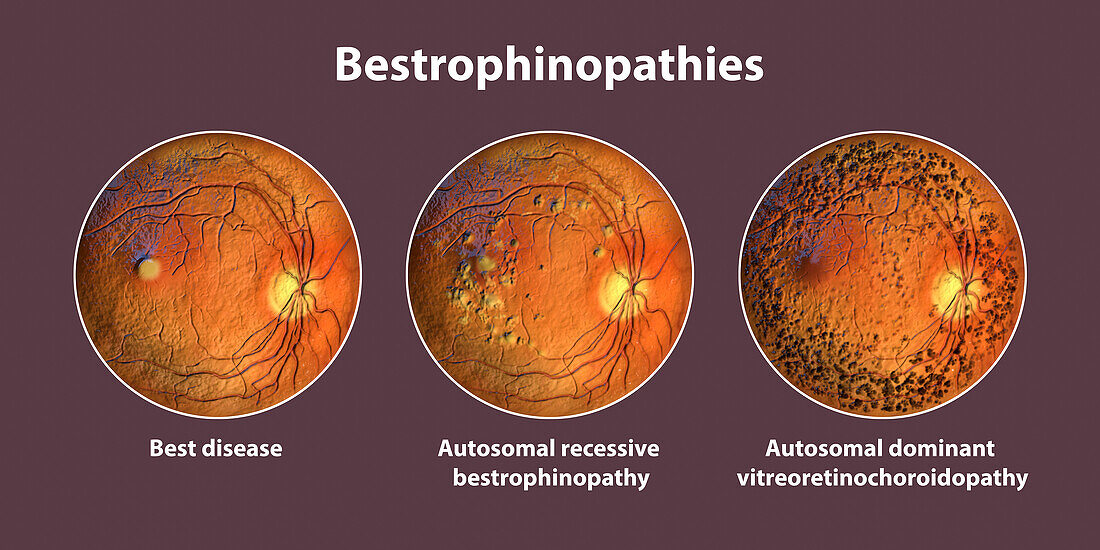 Bestrophinopathies, illustration