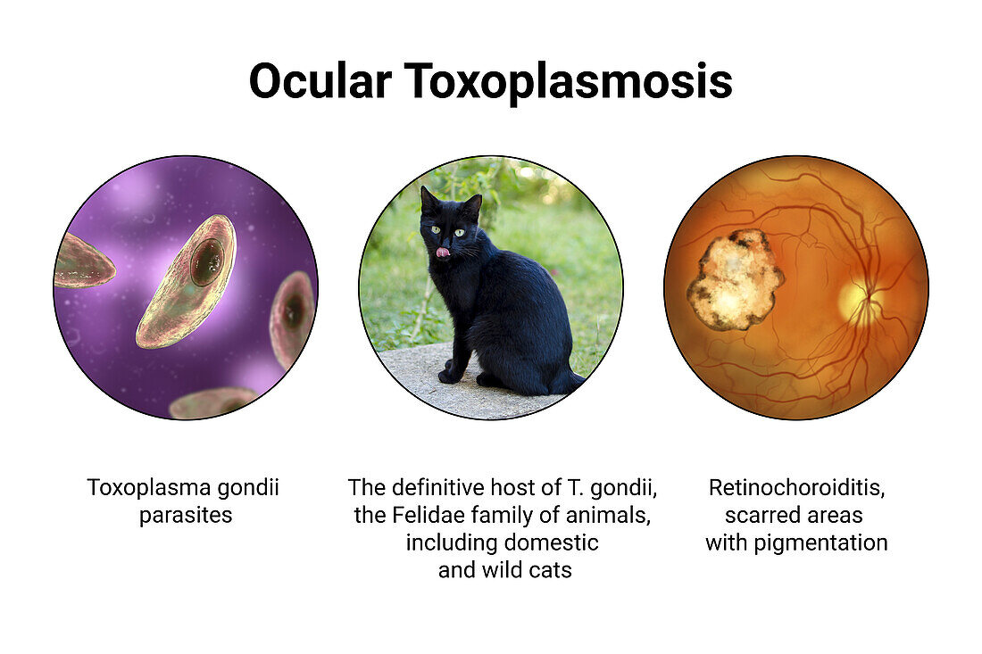 Ocular toxoplasmosis, an illustration