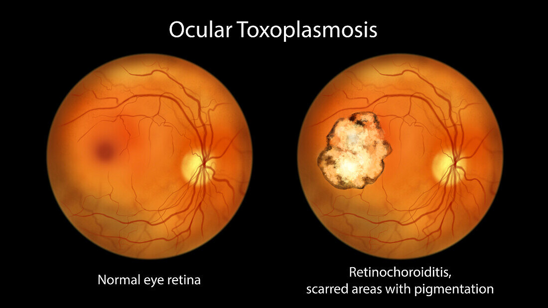 Retinal scar and healthy retina, illustration