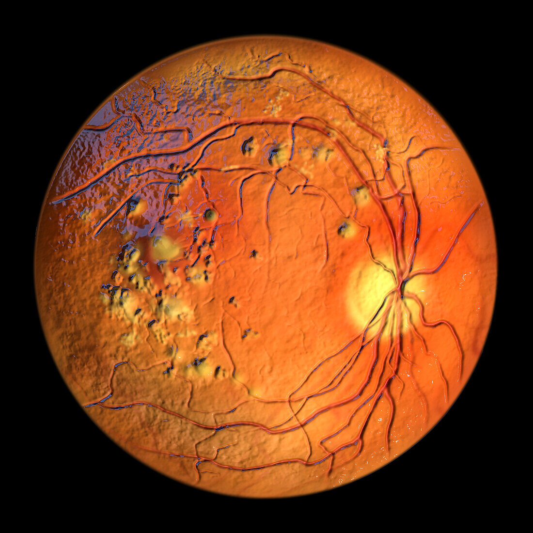 Autosomal recessive bestrophinopathy, illustration