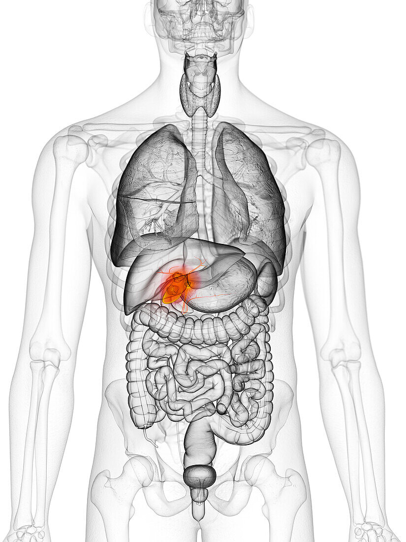 Gallbladder cancer, illustration