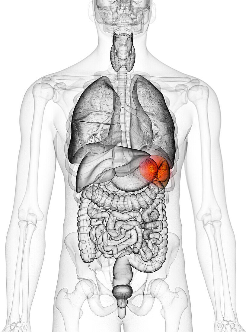 Spleen cancer, illustration