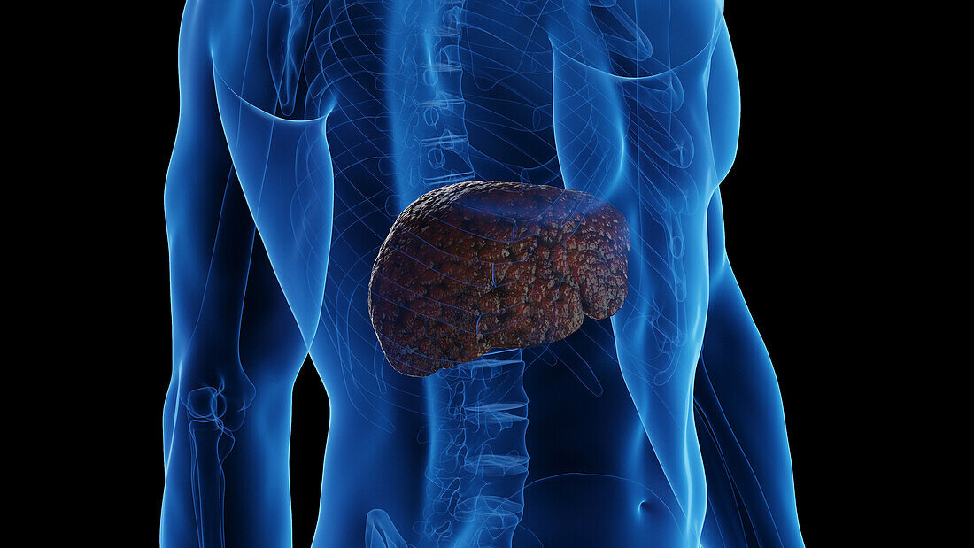 Cirrhotic liver, illustration