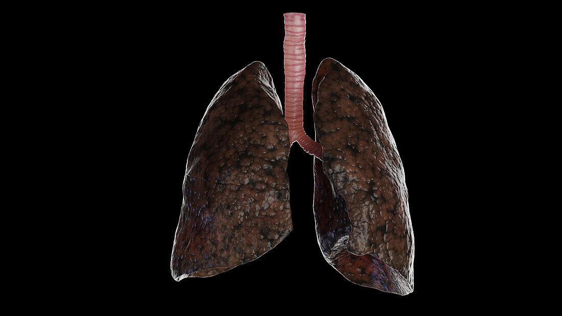 Smoker's lungs, illustration