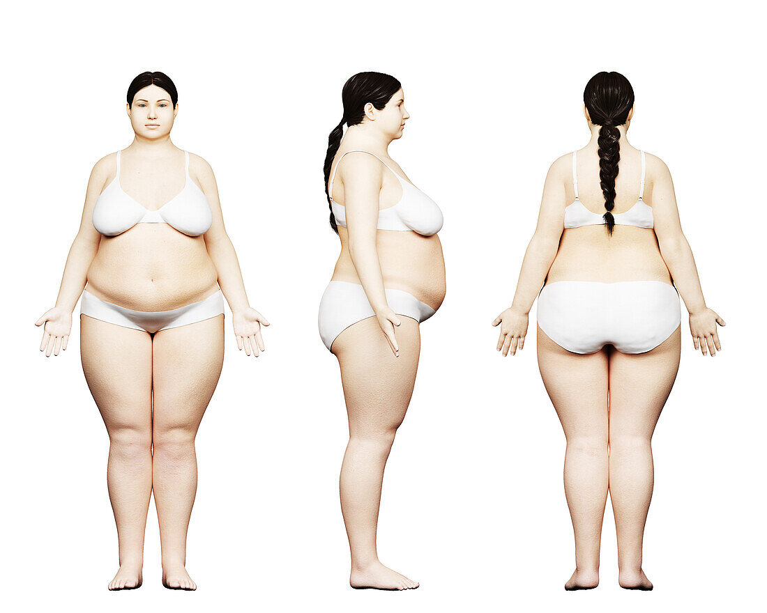 Obese female body, illustration