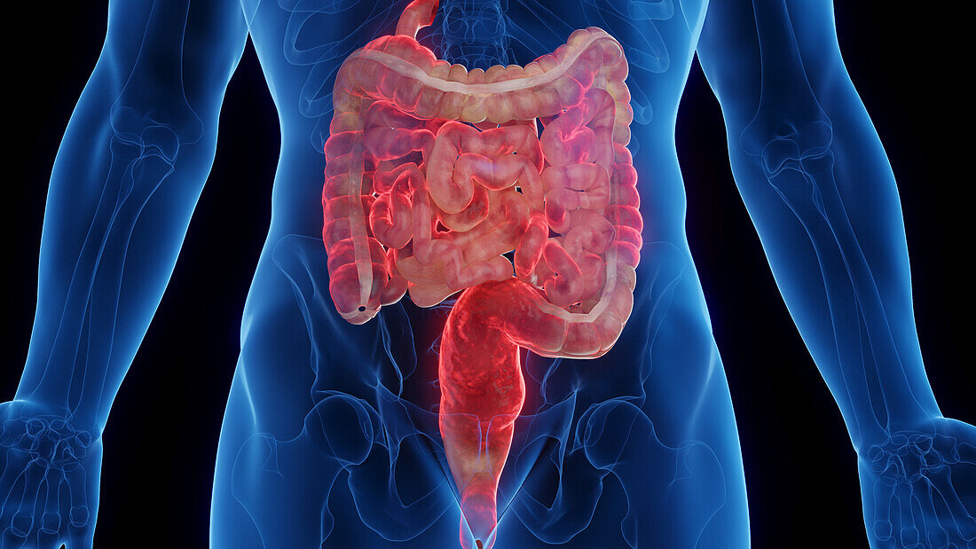 Intestines affected by Crohn's disease, illustration