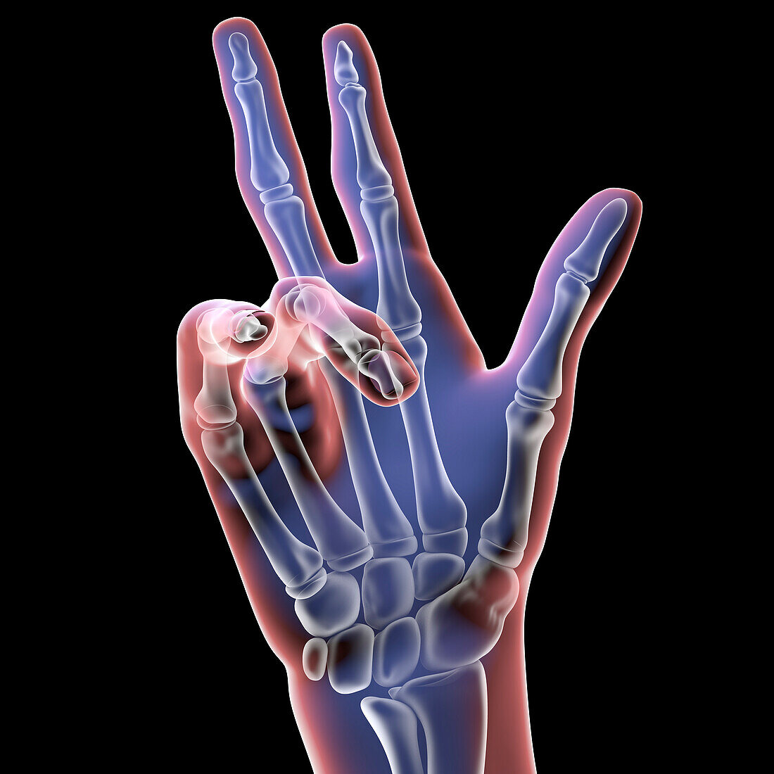 Dupuytren's contracture, illustration