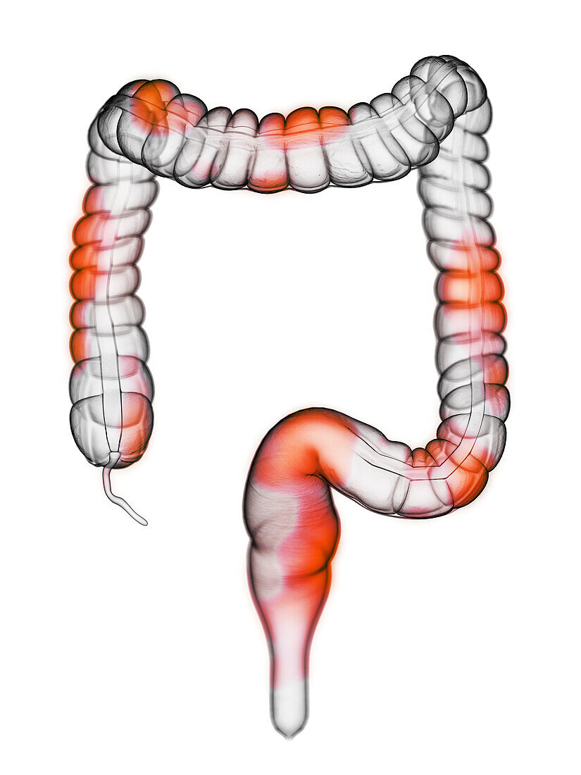 Colon inflammation, illustration