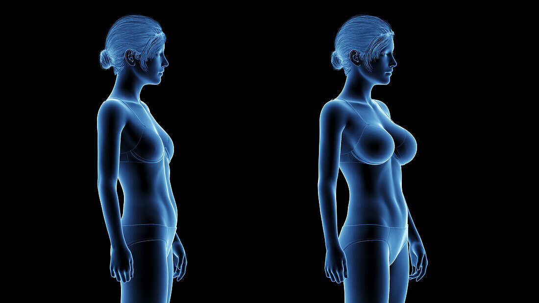 Woman after breast enlargement, illustration