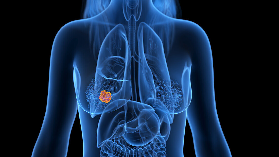 Breast cancer, illustration