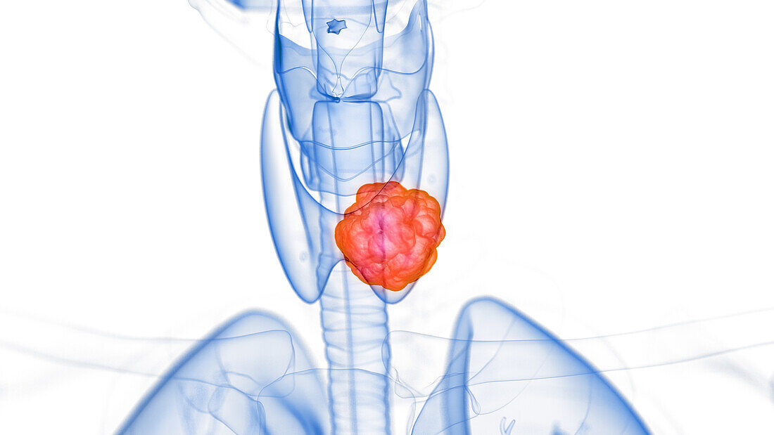 Thyroid tumour, illustration