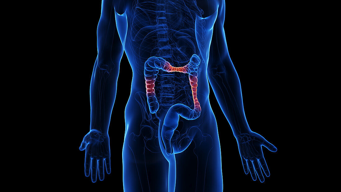 Inflammatory bowel disease, illustration
