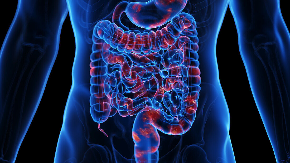 Crohn's disease, illustration