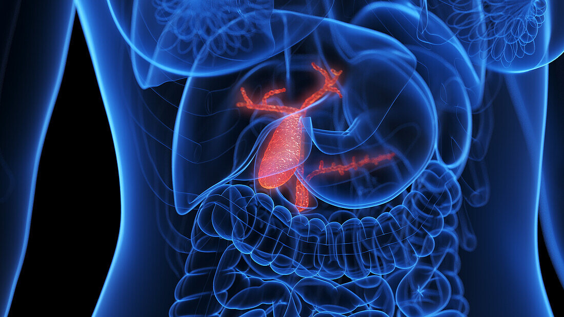 Inflamed gallbladder, illustration