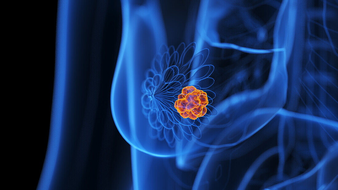 Mammary gland tumour, illustration