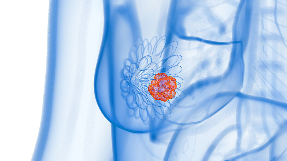 Breast cancer, illustration