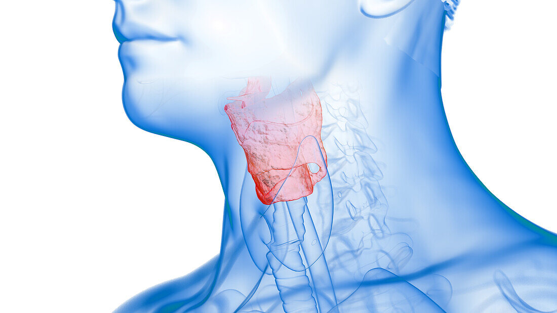 Inflamed larynx, illustration