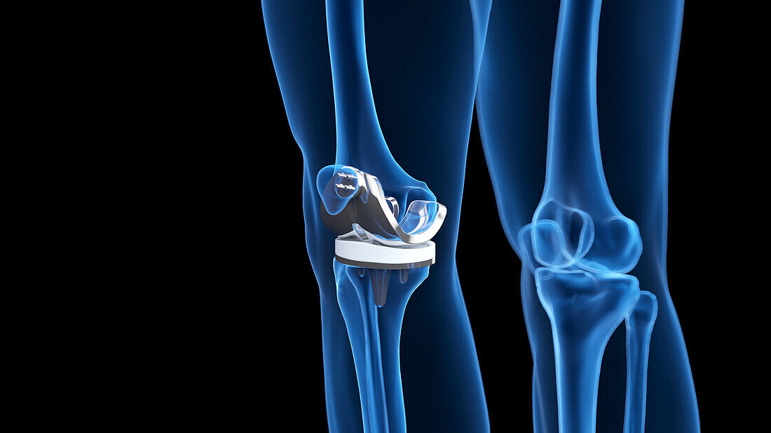 Knee replacement, illustration