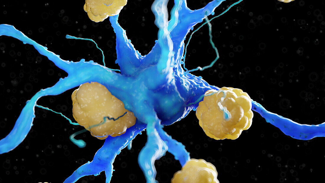 Nerve cell with amyloid plaques, illustration
