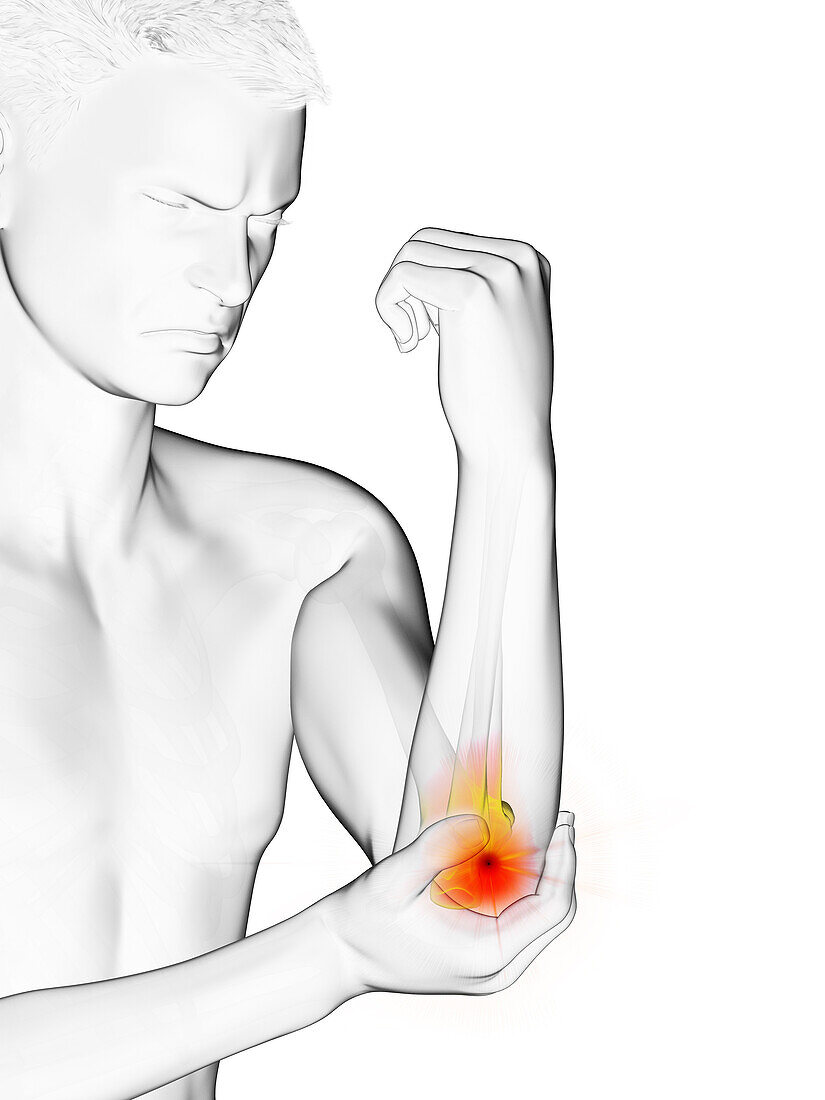 Man with painful elbow, illustration