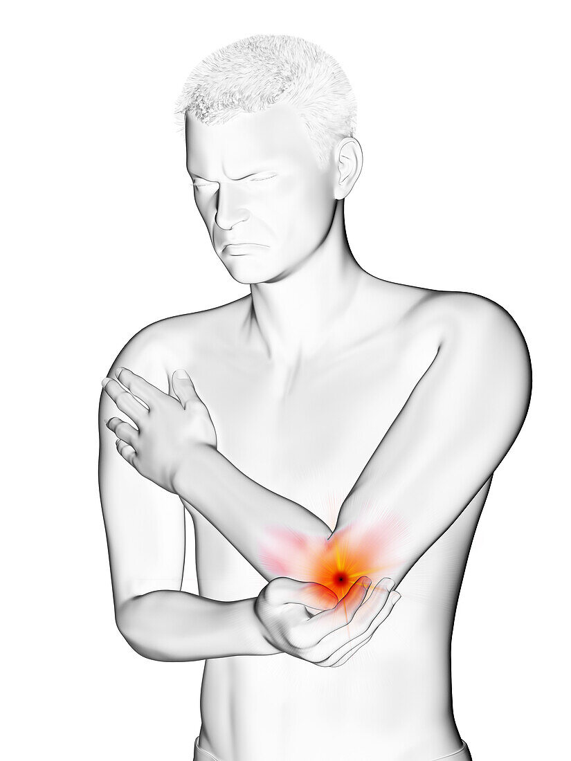 Painful elbow, illustration