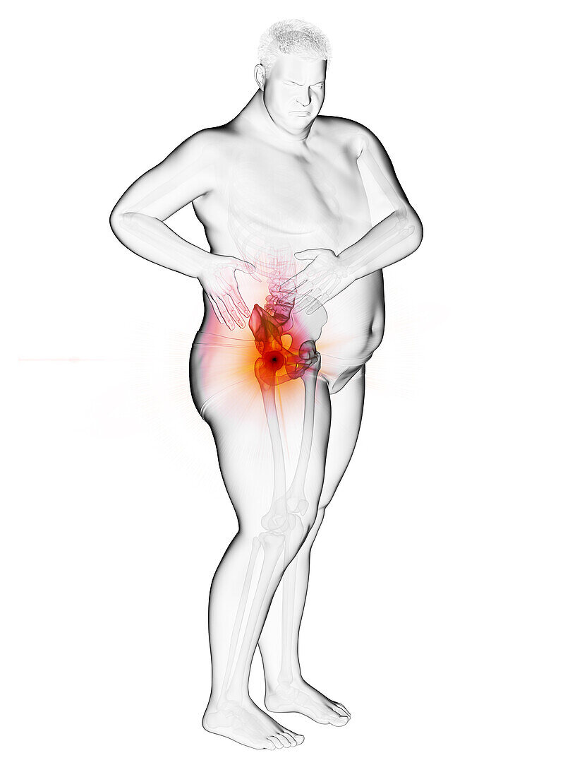 Obese man's painful hip joint, illustration