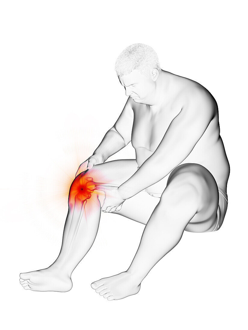 Obese man's painful knee, illustration
