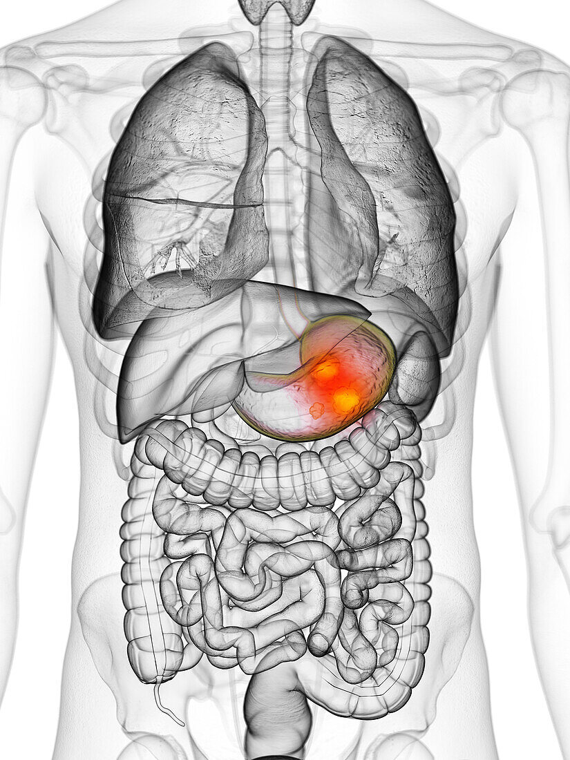 Stomach cancer, illustration