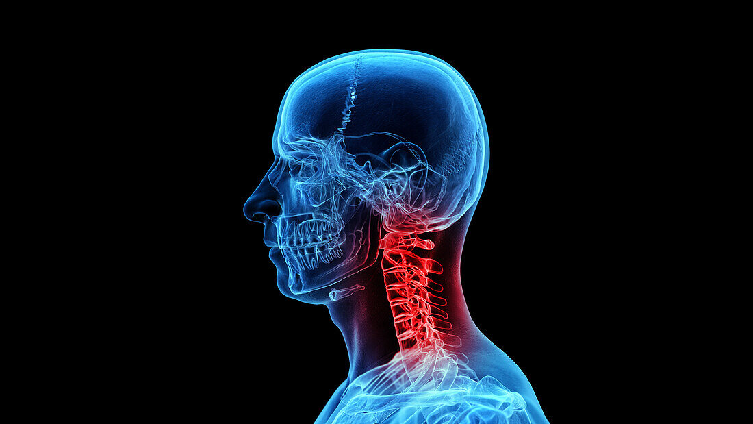 Painful neck, illustration