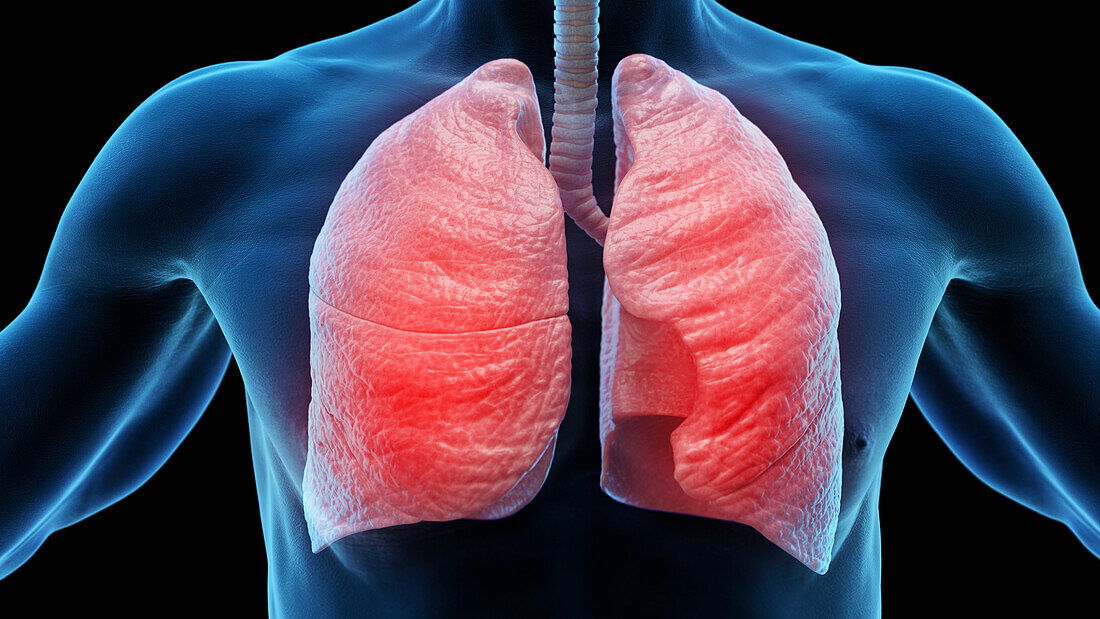 Inflamed lung, illustration