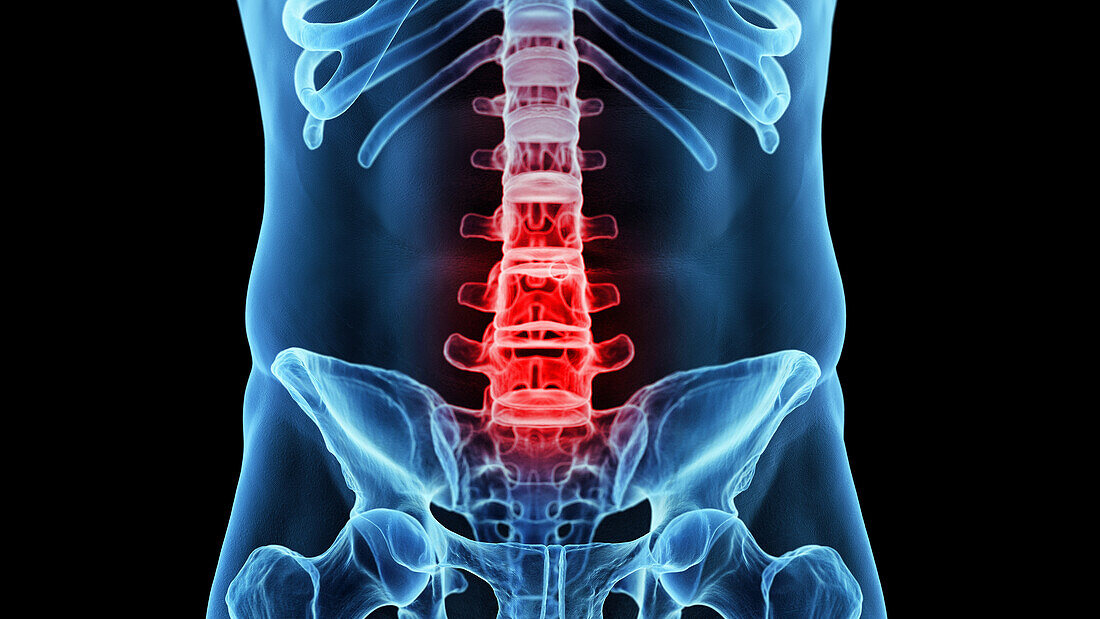 Painful lumbar spine, illustration